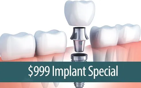 Dental implant special promotion at VCare Family Dental