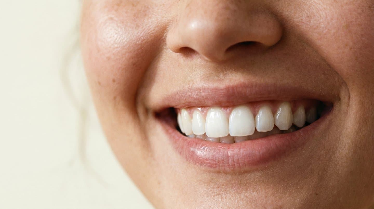 Bright, healthy smile showcasing professional teeth whitening results