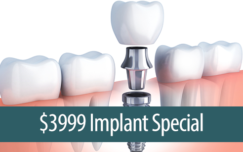 $3999 Implant Special